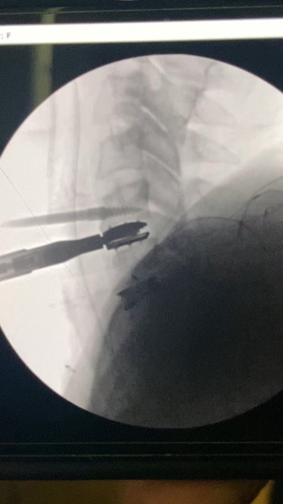 Clements Chiropractic - Footage of how unstable my neck way & how easy the surgeon said he could have really really hurt me badly - Chiropractors Near Me - Long Beach, California