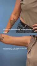 @docmoliver · Scar placement
