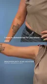 @docmoliver · Scar placement