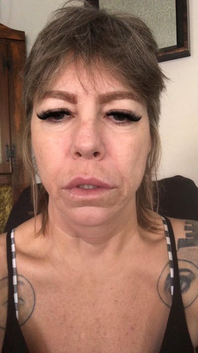 Orange County Plastic Surgery - This is after my first surgery with a drastically crooked lip especially when I spoke. Two other doctors thought I had a stroke. - Cosmetic Surgeons Near Me - Corona del Mar, California