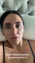 @ashontheglow on what her upper blepharoplasty cost