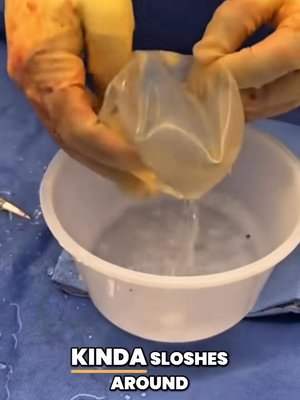 Breast Augmentation result at Ourian Plastic Surgery