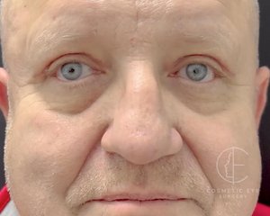 Male Upper Eyelid Surgery Patient Image #1