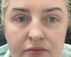 Upper Eyelid Blepharoplasty Patient Image #1