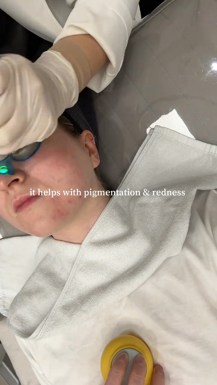 V-beam, IPL, Juvelook, Modelling mask (Benjamin Clinic)