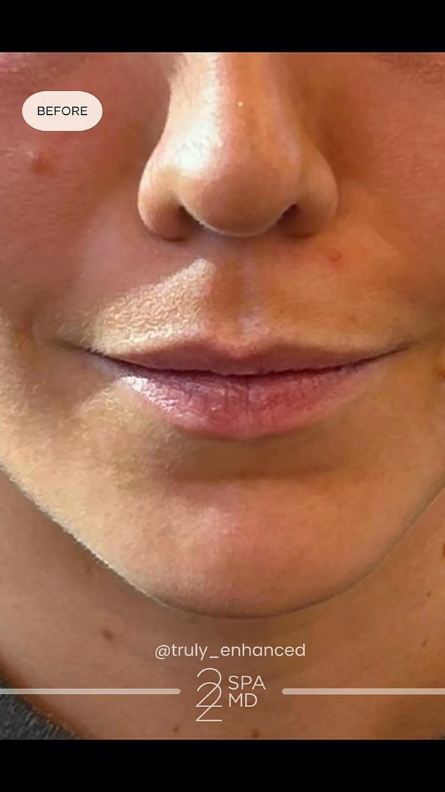 Lip Filler result at 22 Plastic Surgery & Spa MD