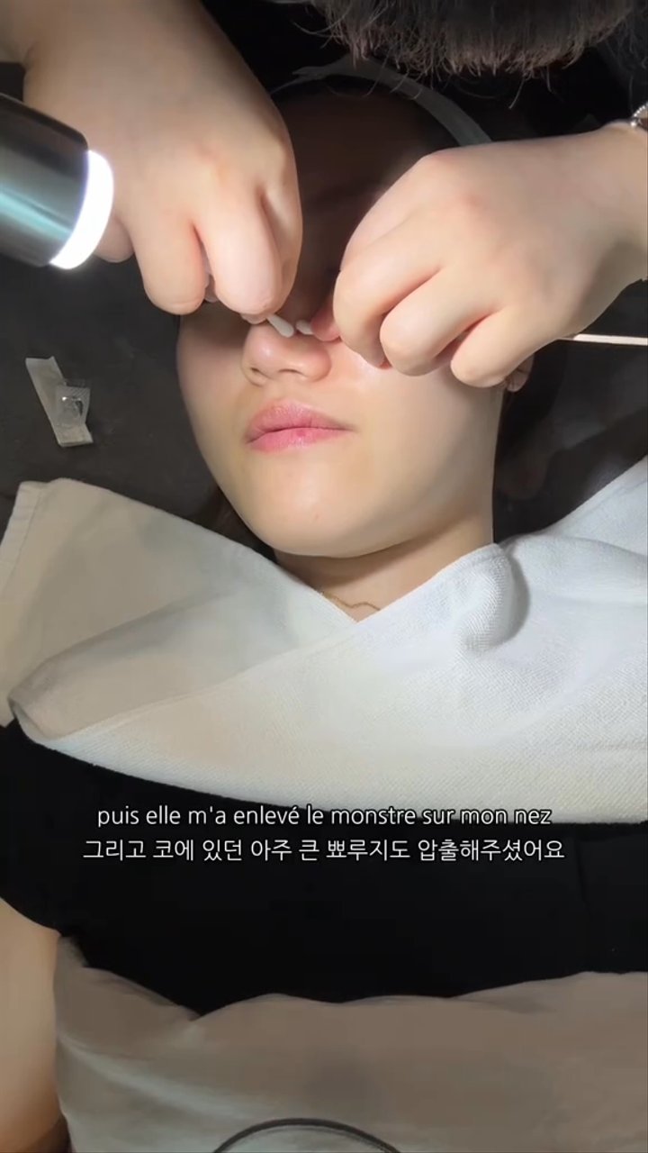 Extraction, Dober Tite, Botox (Chin) (Benjamin Clinic)