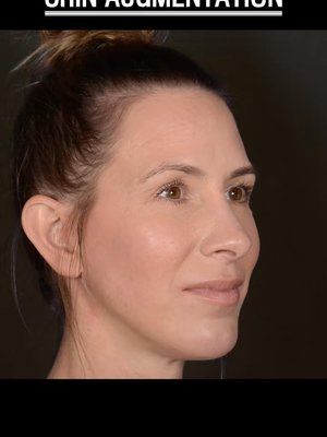 Chin Implant result at Dr. Rady Rahban