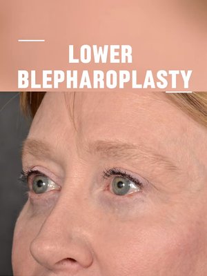 Blepharoplasty result at Dr. Rady Rahban