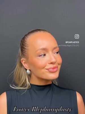 Cheek Implant result at PEAK PLASTIC SURGERY