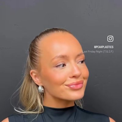 PEAK PLASTIC SURGERY cheek implant result — Salt Lake City, UT