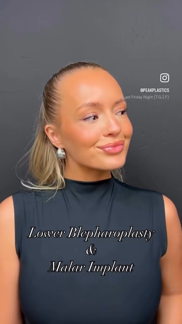 Cheek Implant result at PEAK PLASTIC SURGERY