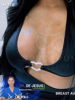 Breast Augmentation result at Spectrum Aesthetics