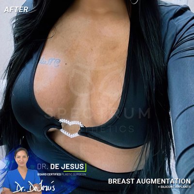 Spectrum Aesthetics breast augmentation result — Miami, FL