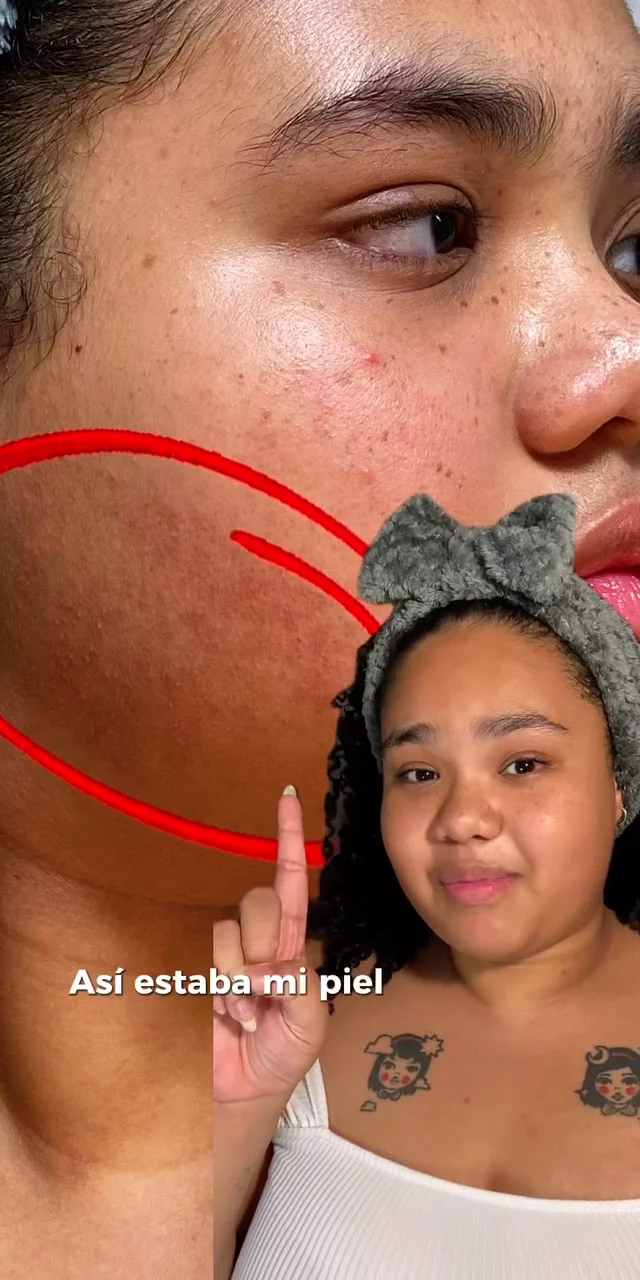 Resultados reales con Mela B3: ¡mi piel sin manchas!