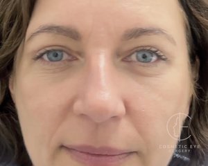 Combo Blepharoplasty & Lower Eyelid CO₂ resurfacing  Patient Image #1
