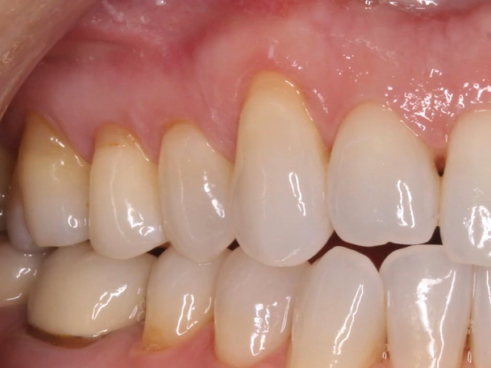 Mona Mahmoodi, DDS - Pinhole Gum Rejuvenation to cover gum recession performed by Dr Mona - Cosmetic Dentists Near Me - Petaluma, California