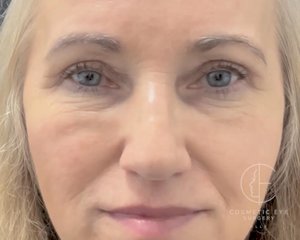 Upper Eyelid Blepharoplasty Patient Image #1
