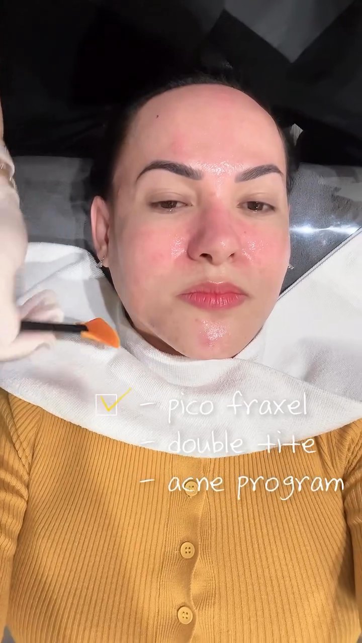 Pico Fraxel, Double Tite, Acne Program (Benjamin Clinic)