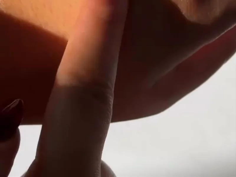Hair Loss video