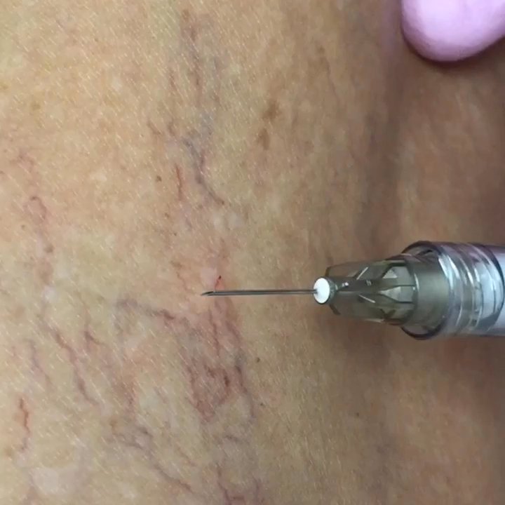 Image Spa MD - Painless spider vein correction from the amazing Nurse Stephanie at Image Spa Md - Medical Spas Near Me - Encinitas, California