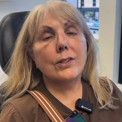 Utah Facial Plastics & UFP Hair Restoration blepharoplasty result — Salt Lake City, UT