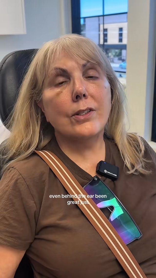 Blepharoplasty result at Utah Facial Plastics & UFP Hair Restoration