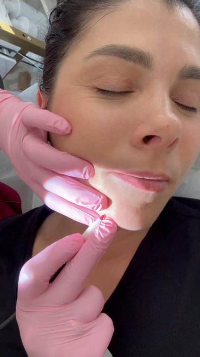 Smooth Sensation Electrolysis - Electrolysis/ hair removal/ Murrieta - Laser Hair Removal Near Me - Murrieta, California