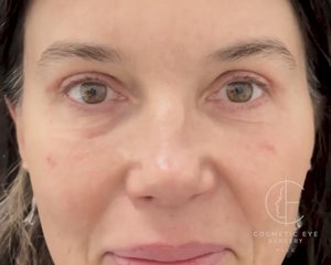 Upper Bhlepharoplasty for Assymetry Patient Image #1