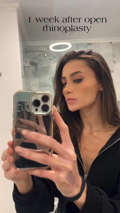 Dr Sean Plastic Surgery - 1 week after an open rhinoplasty with Dr. Sean. So happy with my results! I feel like an instagram filter & this video is w/ zero editing! - Plastic Surgeons Near Me - Beverly Hills, California