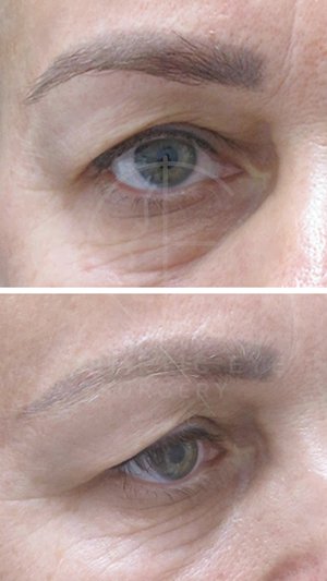 Upper Eyelid Surgery for Asymmetry Patient Image #1