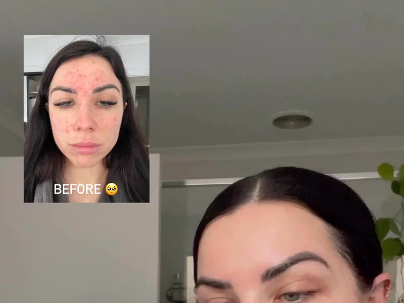 Skincare Routine For Acne Skin