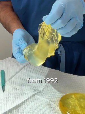 Breast Augmentation result at Dr. York Yates Plastic Surgery