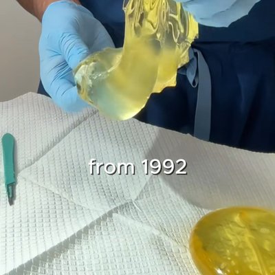 Dr. York Yates Plastic Surgery breast augmentation result — Layton, UT