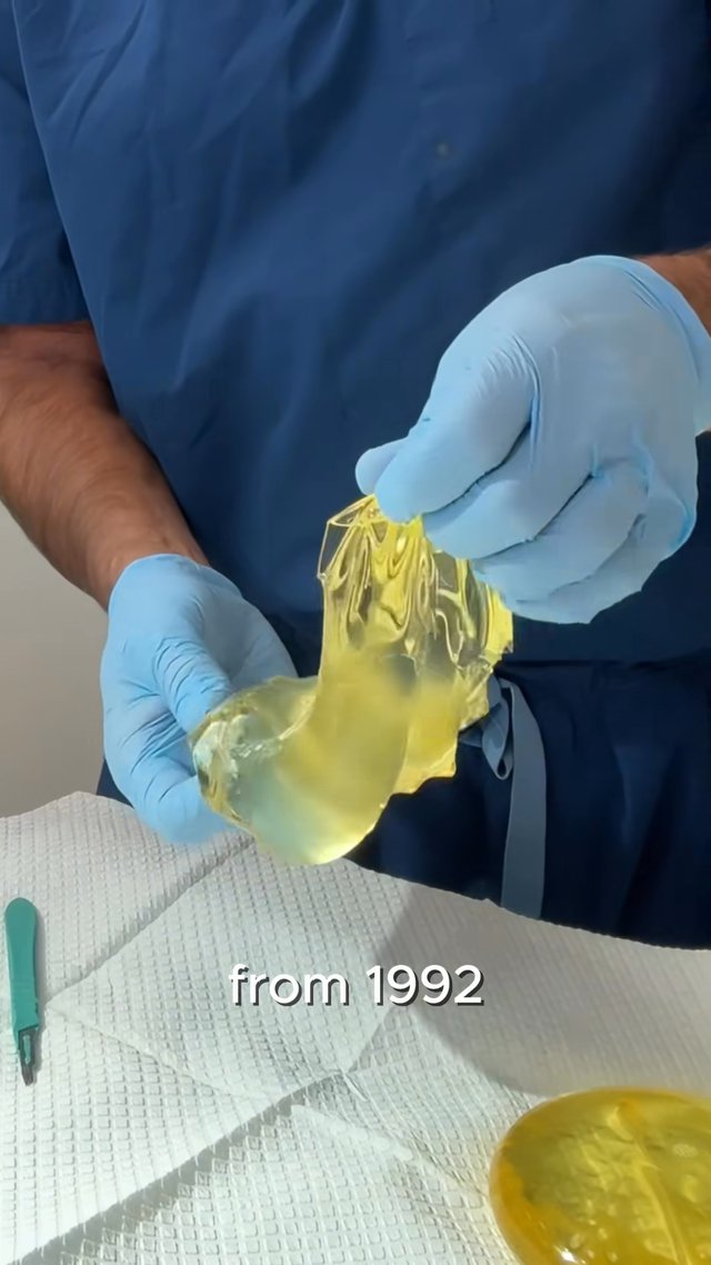 Breast Augmentation result at Dr. York Yates Plastic Surgery