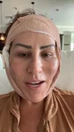 @alikennon, early recovery after a mini/lower facelift