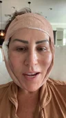 @alikennon, early recovery after a mini/lower facelift