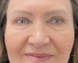 Upper Eyelid Blepharoplasty Patient Image #1