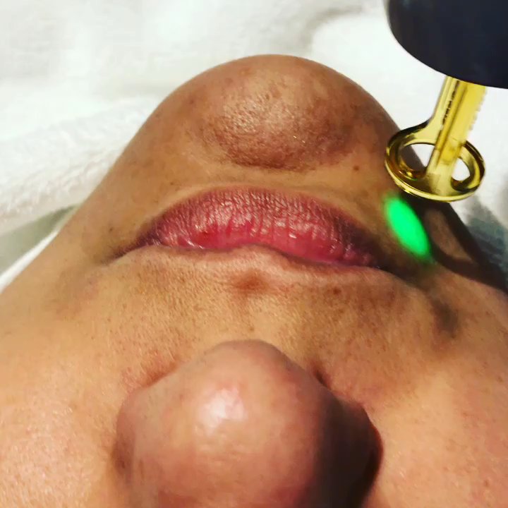 Body Bar Laser Clinic - Laser Lip Rejuvenation - Skin Care Near Me - Coquitlam, British Columbia
