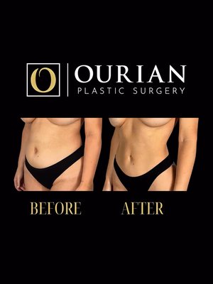 Liposuction result at Ourian Plastic Surgery