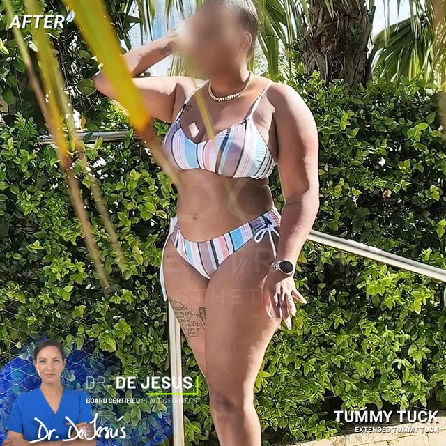 Tummy Tuck result at Spectrum Aesthetics