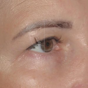 Upper Blepharoplasty for Concealed Permanent Eyeliner Patient Image #1
