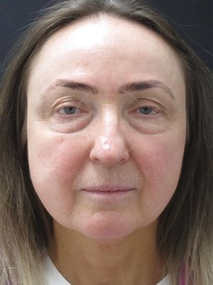 Upper and Lower Eyelid Surgery & Full Face CO₂ LASER Resurfacing Patient Image #1