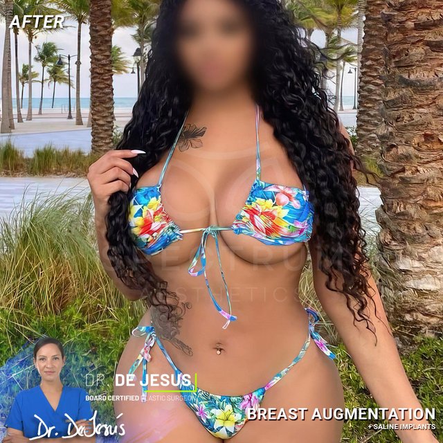 Breast Augmentation result at Spectrum Aesthetics