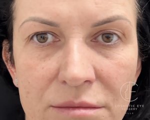 Upper Eyelid Blepharoplasty Patient Image #1