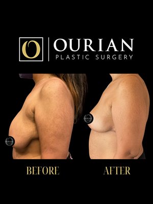 Breast Reduction result at Ourian Plastic Surgery