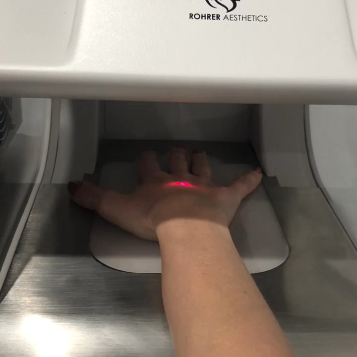 PRFCT - CO2 laser swift scan hand rejuvenation - Medical Spas Near Me - La Jolla, California