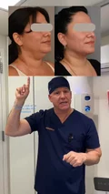 @therealdrsterry on mini versus formal neck lifts