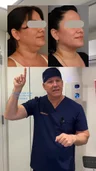 @therealdrsterry on mini versus formal neck lifts