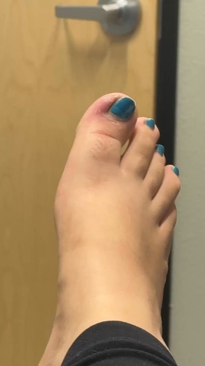 Gallery Nails Bar - Had to eventually go in for a painful surgery after the ingrown I was given an infection from the nail tech cutting down the side of my nail - Nail Salons Near Me - Queen Creek, Arizona